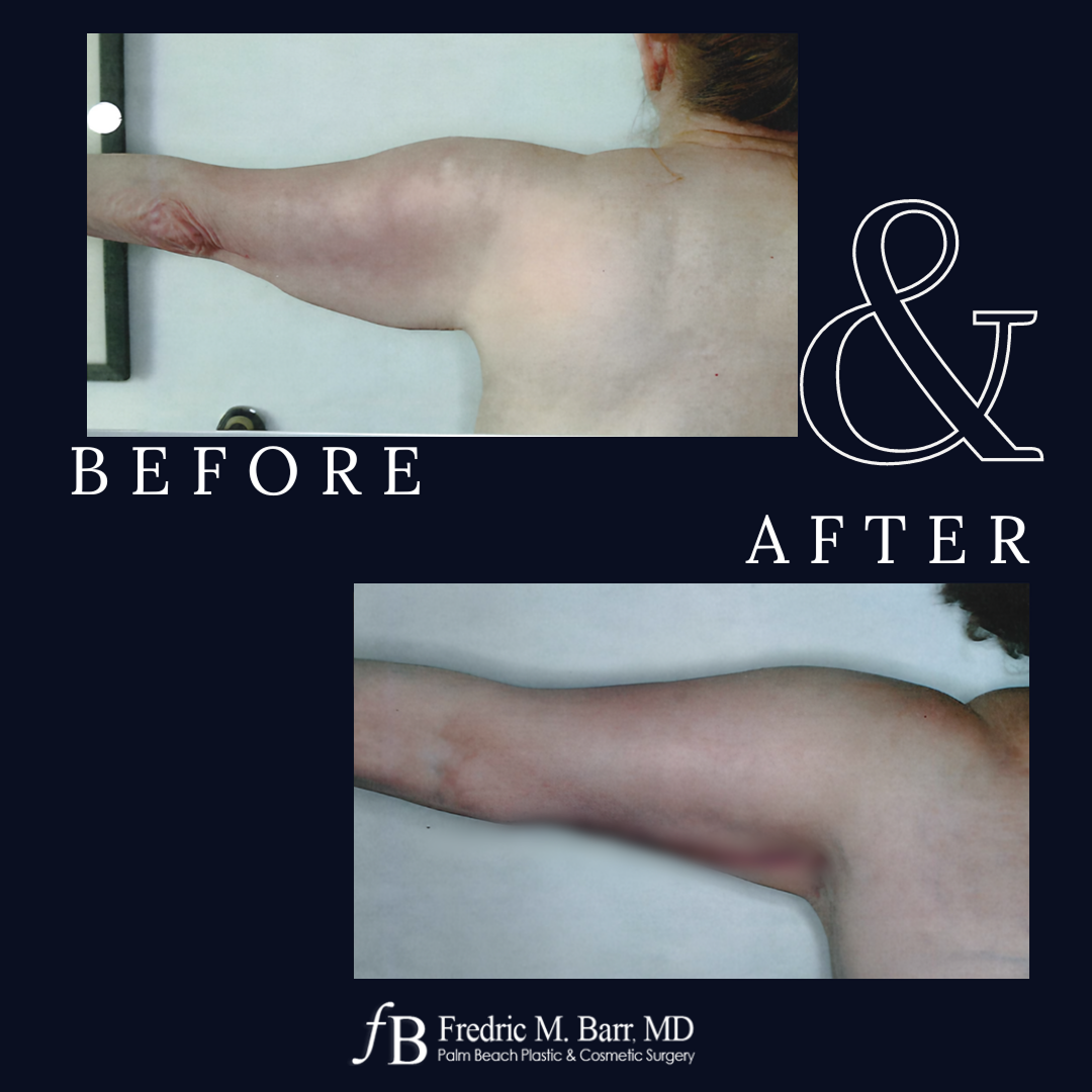 Arm Lift Surgery in West Palm Beach, FL | Call (561) 833-4122