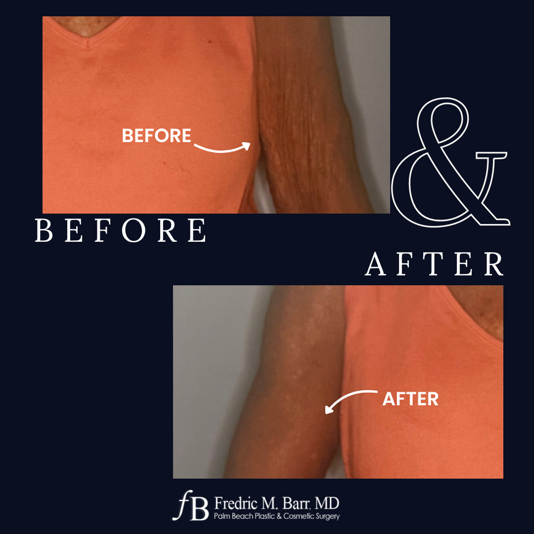 Arm Lift Surgery in West Palm Beach, FL | Call (561) 833-4122