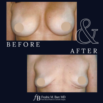 Implant Explantation (Total Capsulectomy) 11 Implant Explantation with a Lift Surgery in West Palm Beach Florida | Call (561) 833-4122