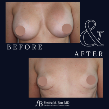 Implant Explantation (Total Capsulectomy) 10 Implant Explantation with a Lift Surgery West Palm Beach Florida | Call (561) 833-4122