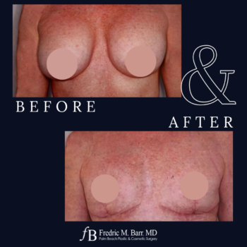Implant Explantation (Total Capsulectomy) 9 West Palm Beach, FL Implant Explantation with a Lift Surgery | Call (561) 833-4122