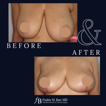 Breast Reduction 6 Breast reduction Surgery in West Palm Beach, FL | Call (561) 833-4122