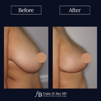 Breast Reduction 7 Breast Reduction Surgery West Palm Beach, FL | Call (561) 833-4122