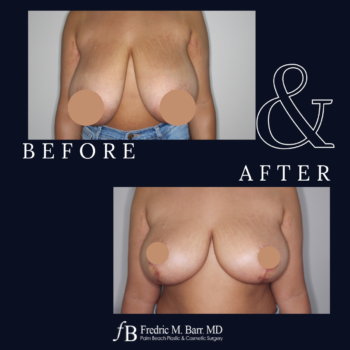 Breast Reduction 8 Breast reduction Surgery in West Palm Beach, FL | Call (561) 833-4122