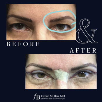 Eyelid Lift 3 Eyelid Lift Surgery in West Palm Beach, FL | Call (561) 833-4122