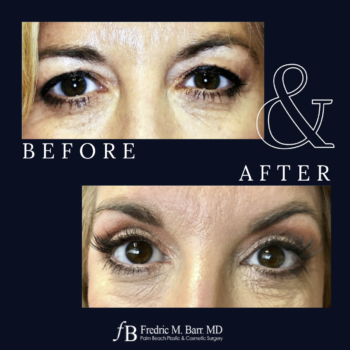 Eyelid Lift 4 West Palm Beach Eyelid Lift Surgery | Call (561) 833-4122