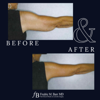 Arm Lift (Brachioplasty) 6 Arm Lift Surgery in West Palm Beach, FL | Call (561) 833-4122