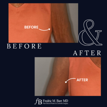 Arm Lift (Brachioplasty) 5 Arm Lift Surgery in West Palm Beach, FL | Call (561) 833-4122