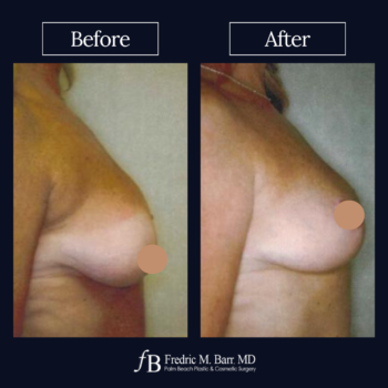 Breast Lift 4 Breast Lift Surgery West Palm Beach | Call (561) 833-4122