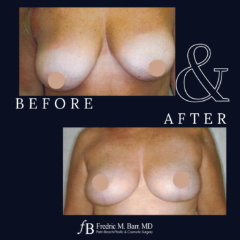 Breast Lift 6 Breast Lift Surgery West Palm Beach, FL | Call (561) 833-4122