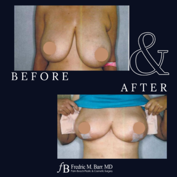 Breast Lift 5 Breast Lift Surgery in West Palm Beach, Florida | Call Now (561) 833-4122