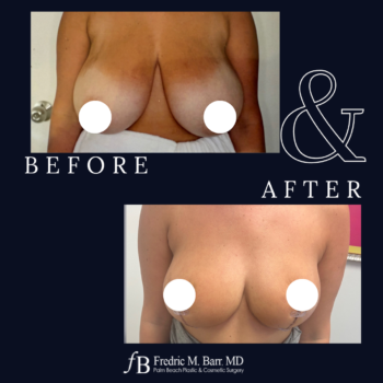 Breast Reduction 5 Breast reduction Surgery in West Palm Beach | Call (561) 833-4122