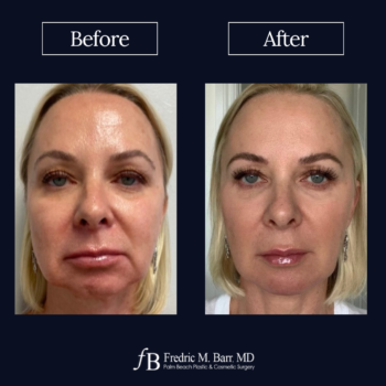 Dermal Filler 20 Derma Filler West Palm Beach Florida | Call (561) 833-4122