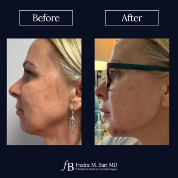 Dermal Filler 22 West Palm Beach, FL Derma Filler | Call (561) 833-4122