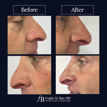 Dermal Filler 12 West Palm Beach Derma Filler | Call (561) 833-4122