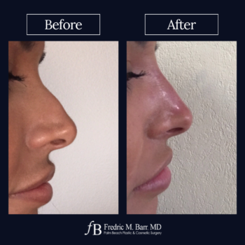 Dermal Filler 13 Derma Filler West Palm Beach | Call (561) 833-4122