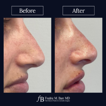 Dermal Filler 14 Derma Filler West Palm Beach Florida | Call (561) 833-4122