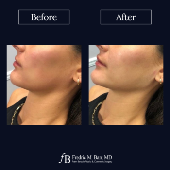 Dermal Filler 16 Derma Filler West Palm Beach, FL | Call (561) 833-4122