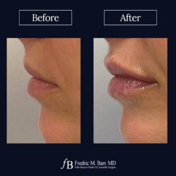 Dermal Filler 17 Derma Filler in West Palm Beach, FLorida | Call (561) 833-4122