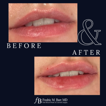 Dermal Filler 18 Derma Filler in West Palm Beach | Call (561) 833-4122