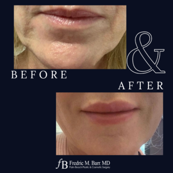 Dermal Filler 19 Derma Filler in West Palm Beach Florida | Call (561) 833-4122