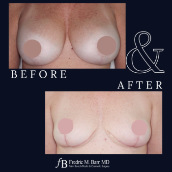 Implant Explantation (Total Capsulectomy) 14 Implant Explantation with a lift Surgery in West Palm Beach, FL | Call (561) 833-4122