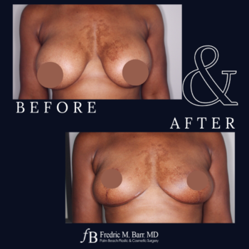 Implant Explantation (Total Capsulectomy) 12 Implant Explantation with a Lift Surgery West Palm Beach, FL | Call 561-833-4122