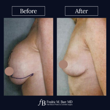 Implant Explantation (Total Capsulectomy) 13 For Implant Explantation with a Lift Surgery in West Palm Beach, FL | Call (561) 833-4122