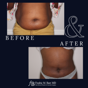 Liposuction 4 Liposuction Surgery in West Palm Beach, FL | Call (561) 833-4122