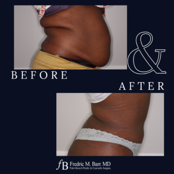 Liposuction 5 West Palm Beach, FL Liposuction Surgery | Call (561) 833-4122