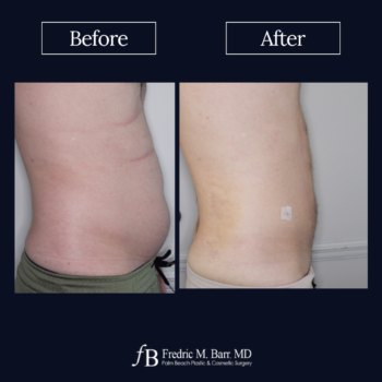 Liposuction 6 Liposuction Surgery West Palm Beach | Call (561) 833-4122