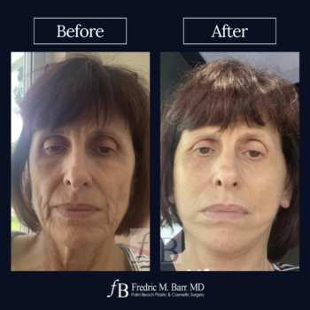 Mini Face Awake Surgery West Palm Beach | Call (561) 833-4122