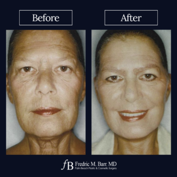 Mini Face Awake Surgery in West Palm Beach FL | Call (561) 833-4122