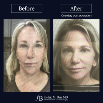 Mini Face Awake Surgery West Palm Beach Florida | Call (561) 833-4122