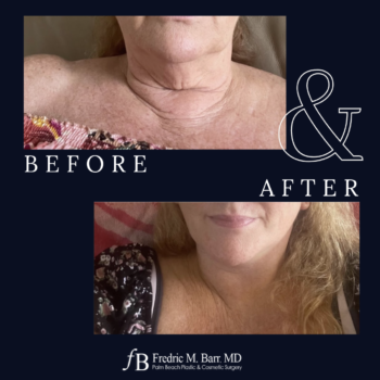 Mini Neck Lift 4 West Palm Beach Mini Neck Lift Surgery | Call (561) 833-4122