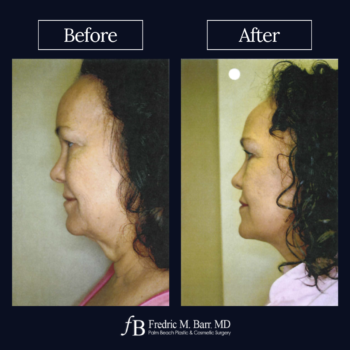 Mini Neck Lift 5 Mini Neck Lift Surgery in West Palm Beach Florida | Call (561) 833-4122