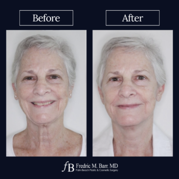 Mini Neck Lift 6 West Palm Beach FL Mini Neck Lift Surgery | Call (561) 833-4122