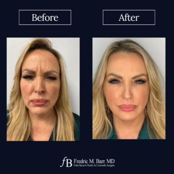 Neuromodulators 2 Neuromodulators Gallery | Palm Beach Plastic & Cosmetic Surgery | Call (561) 833-4122