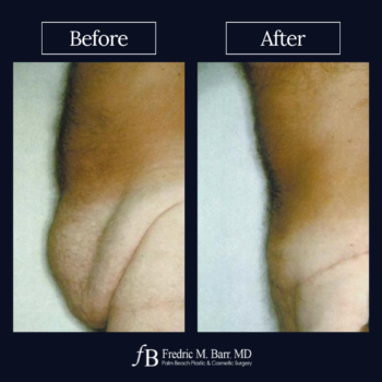 Tummy Tuck 3 Tummy Tuck Surgery in West Palm Beach, FL | Call (561) 833-4122