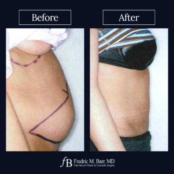 Tummy Tuck 4 West Palm Beach Tummy Tuck Surgery | Call (561) 833-4122