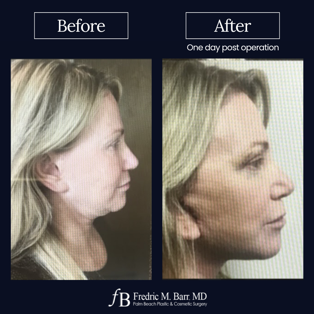 Mini Face Awake Surgery in West Palm Beach, FL | Call (561) 833-4122